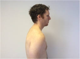 An anterior tilt of the scapula is one where the inferior border is more prominent than the superior border.